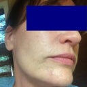 043013 - right side -- moisturizer, makeup and a giant pimple!