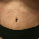 11 days post op.  New belly button.  Tummy is flat with very little visible stretch marks.