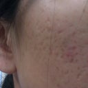 Before Treatment - Left Side