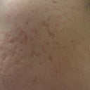 Before Treatment - Right Side