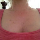1 week after 15 moles were removed! all gone! amazing!