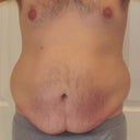 Day of surgery 12-7-12