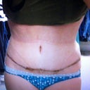 After-10 days post op front view