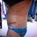 After-10 days post op-side view