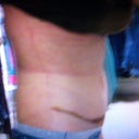 After-another side view-10 days PO