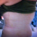After-back view 10 days PO.