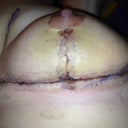 Right side. Pretty swollen and still pretty bruised. I was actually surprised to see how bruised it was tonight when looking at the pictures.
