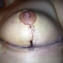 Left side. You can see where it is draining a little towards the center of my chest or left side of the picture. The opening is not even noticeable as I am still taped.