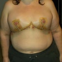 Day 3 post op