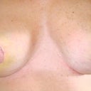 One week later. Left breast is still swollen. 