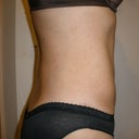 12 weeks post-op