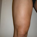 12wees post-op