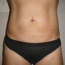 12 weeks post-op
