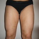 4 weeks post-op