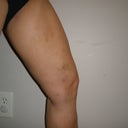 4 weeks post-op