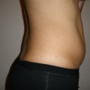 Day Before Surgery