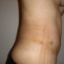 1 Week Post-op