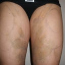 1 Week Post-op
