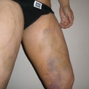 1 Week Post-op bruising