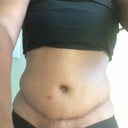 7 weeks post op