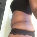 7 weeks post op left side