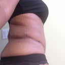 7 weeks PO right side (the dog ear is still there but does not look as pronounced)