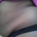 Side Dunlap view/Flap of Skin result of C-sections