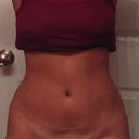 Day 4- swelling is back down :)