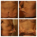 Excess skin due to my weight loss