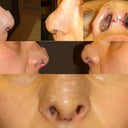 nose different angles - 3rd day after rhinoplasty