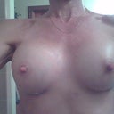 two weeks after. I already started to use silicone gel.