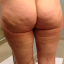Day 13 - Back Side - as you can tell, it looks like the same cellulite that was originally there. I'm going to hold out until 6 or more weeks until I decide if it was worth it or not.  I'm being patient and expecting results for the $7k I paid.