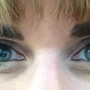 I am really starting to see a reduction in swelling now..the scar has reduced quite a bit already too.