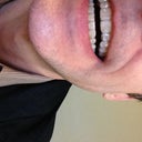 You can see how the canine didn't track with the aligner. Attachment failed. Sadly.