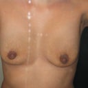 1 week After op.