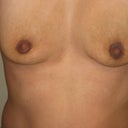 12 days after op.