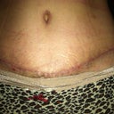 9 weeks scar