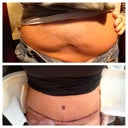 Before and 2 days post op