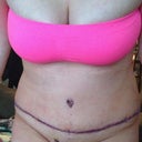 3 days post op