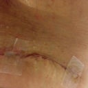 Incision on right side where I had a suture that my friend removed. Jagged n weird but below panty line. This is almost 3 weeks post op.