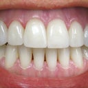 Teeth Whitening & Veneers Before & After Photo