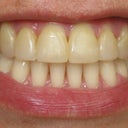 Teeth Whitening & Veneers Before & After Photo