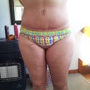 2 months P/O front scar
