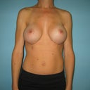 6 months post op