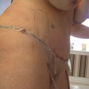 side view 1 week post op with drains in.