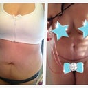 Before & Post-oP DaY 3