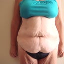 pre surgery taken july 2011