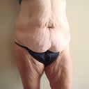 turkey sag on those thighs pre-surgery