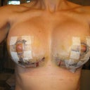 6 days post-op front still looking like frankenboobies, cant wait for the strips to come off