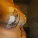 6 days post-op right side